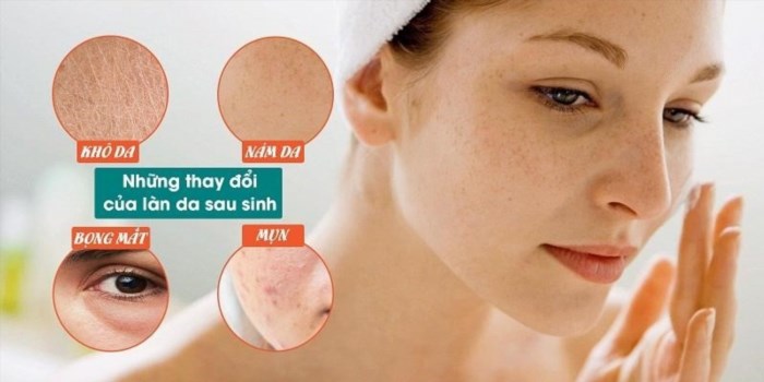 Vấn đề phổ biến của da mặt sau khi sinh thường xuyên xảy ra.
