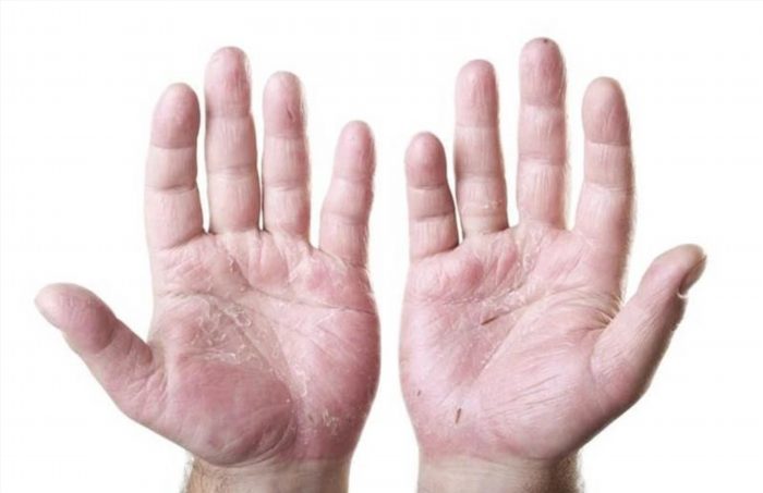 Da tay khô nứt nẻ chảy máu là do da mất độ ẩm, thiếu dưỡng chất và bị tổn thương. Điều này có thể xảy ra do tác động của thời tiết khắc nghiệt, sử dụng các sản phẩm chứa hóa chất gây kích ứng, hoặc do không chăm sóc da tay đúng cách.